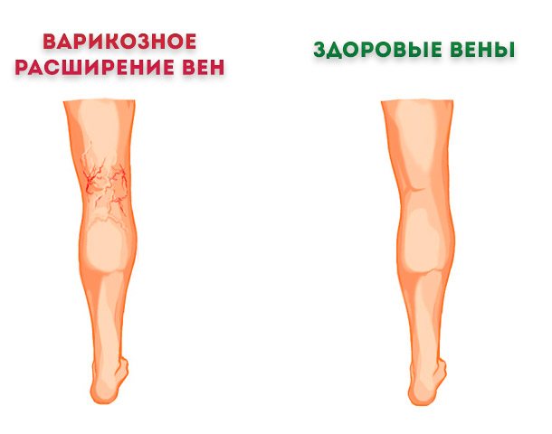 При варикозному розширенні вен