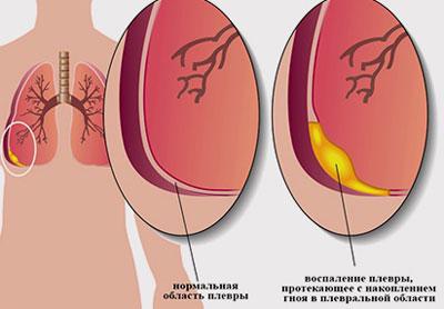 Причини гнійного плевриту легких: ускладнення і методи лікування