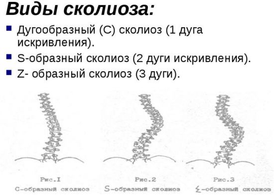 Причини викривлення хребта у дорослих лікування