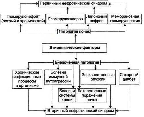 Причини нефротичного синдрому