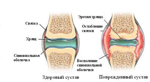 причини ревматоїдного артриту