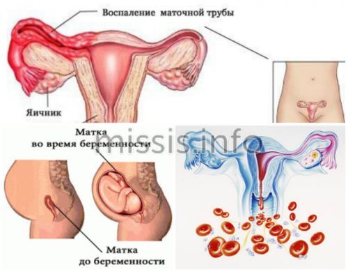 Причини виникнення запалення апендикса