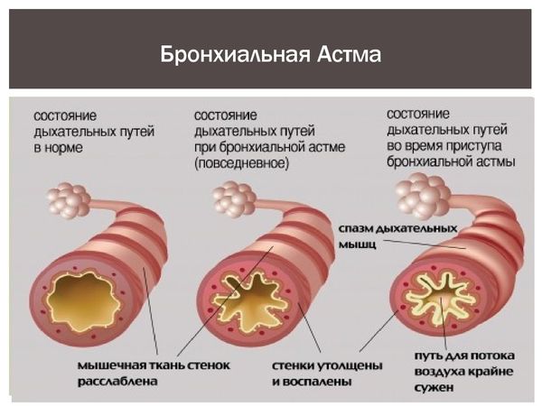 Застосування препарату Бронхипрет для лікування дітей: інструкція, дозування, аналоги і огляд відгуків