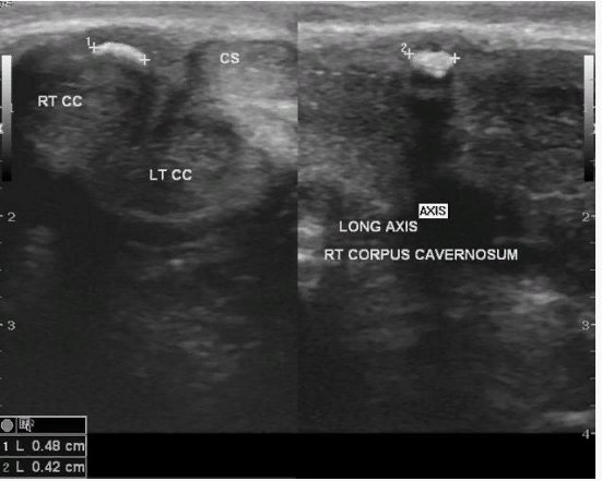 Ознаки хвороби Пейроні на УЗД: бляшки на знімку (позначені маркерами-хрестиками, в лівому нижньому кутку встановлені розміри)