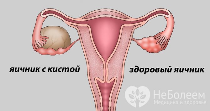 Ознаки ендометріоїдних кісти яєчника