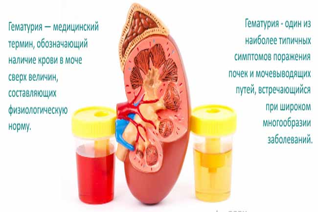 ознаки гематурії