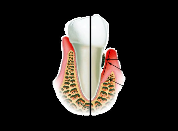 Ознаки гінгівіту і пародонтиту