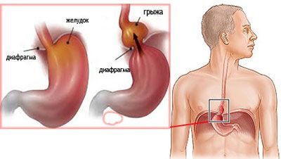 Ознаки грижі стравохідного отвору діафрагми