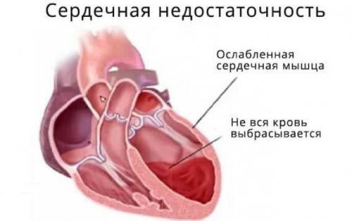 Ознаки серцевої недостатності