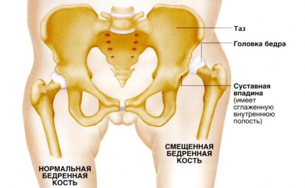 Ознаки вродженого вивиху стегна у дітей