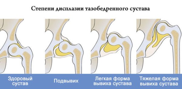 Ознаки вродженого вивиху стегна у дітей