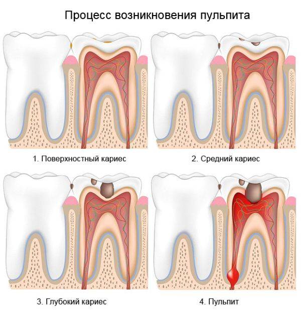 Процес виникнення пульпіту