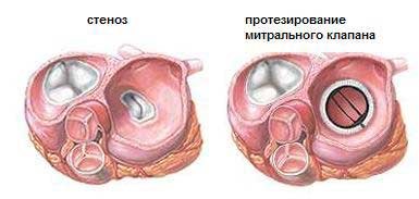 Стеноз трикуспидального клапана это