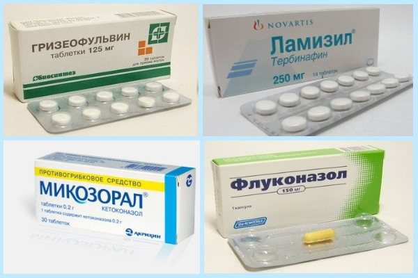 Симптоми грибкової ангіни у дітей і лікування інфекції протигрибковими препаратами Симптоми грибкової ангіни у дітей і лікування інфекції протигрибковими препаратами