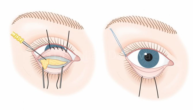 Транскон’юктівальная блефаропластика: що це таке, фото до і після