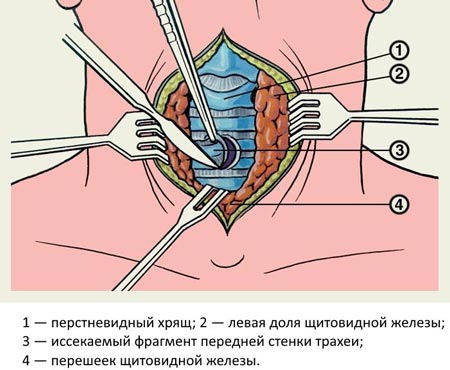 проведення трахеостомии