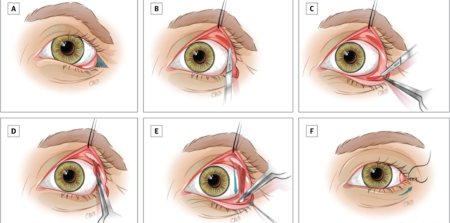 Провисання нижньої повіки після блефаропластики