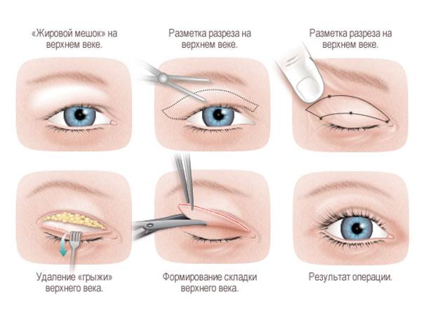 Провисання нижньої повіки після блефаропластики