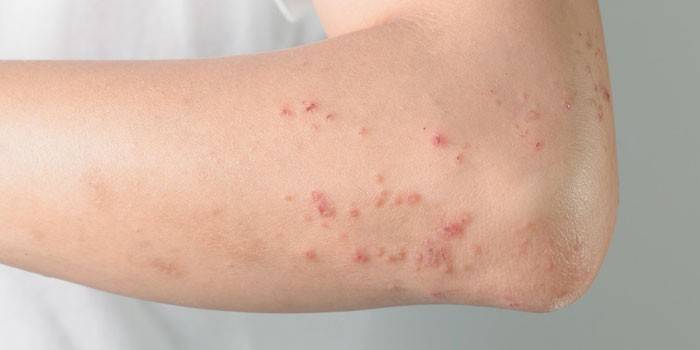 Прояви алергії на шкірі руки