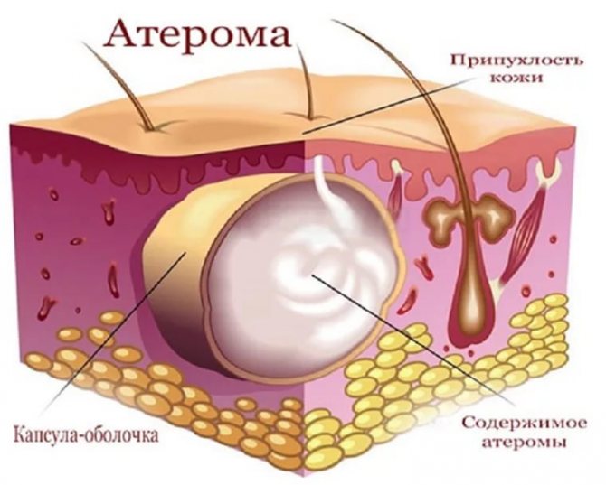 Прищ на соску - що це, білий, біля, навколо, як позбутися, у дитини, фото