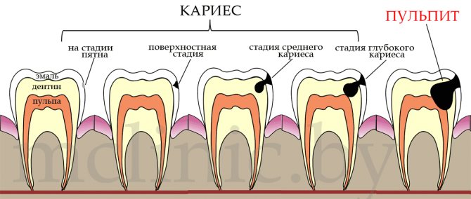 Пульпіт: симптоми, причини виникнення, лікування, фото