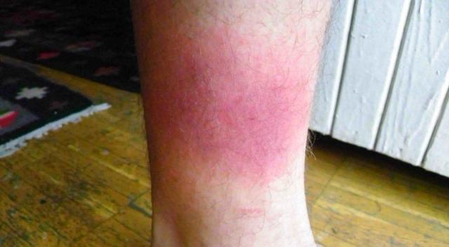 Плями на нозі: червона пляма на ногах фото, причини
