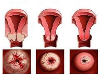 Дисплазия шейки матки 3 степени отзывы