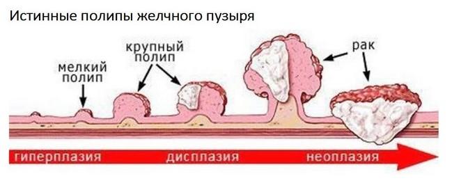 Рак і поліп