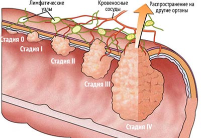 рак на різних стадіях в прямій кишці