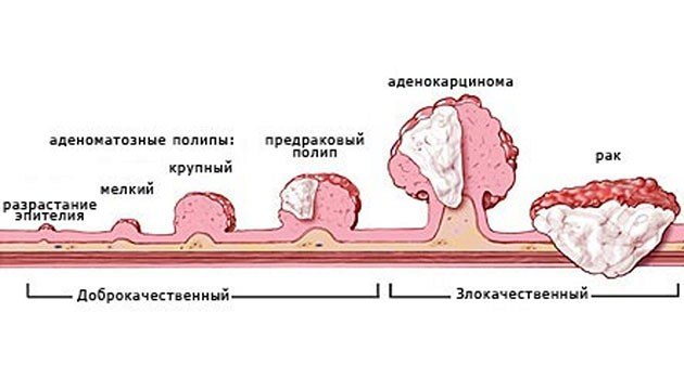 Рак передміхурової залози (простати): все симптоми, діагностика, лікування, виживання