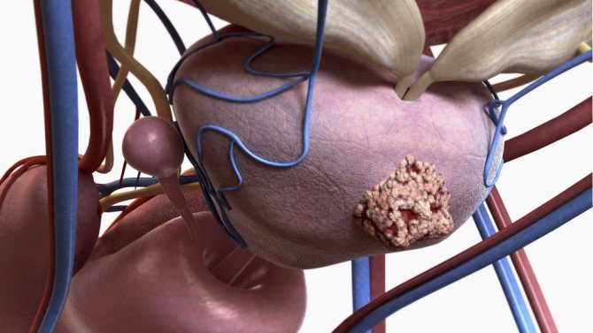 Рак передміхурової залози (простати): все симптоми, діагностика, лікування, виживання