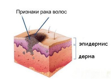 рак волосся