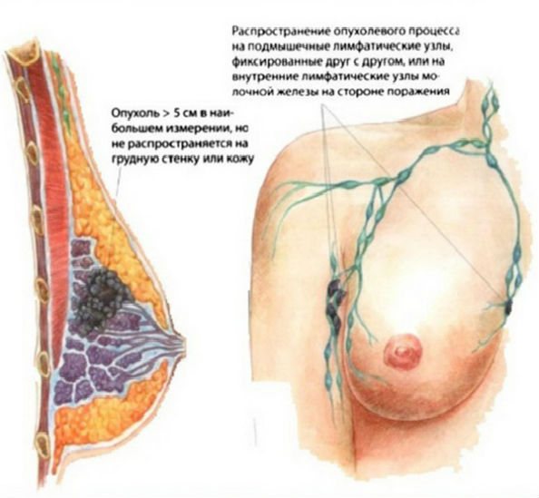 поширення раку грудей