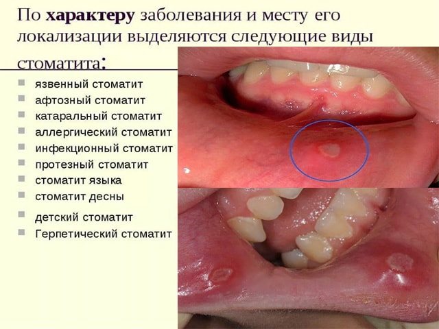 різниця болещні