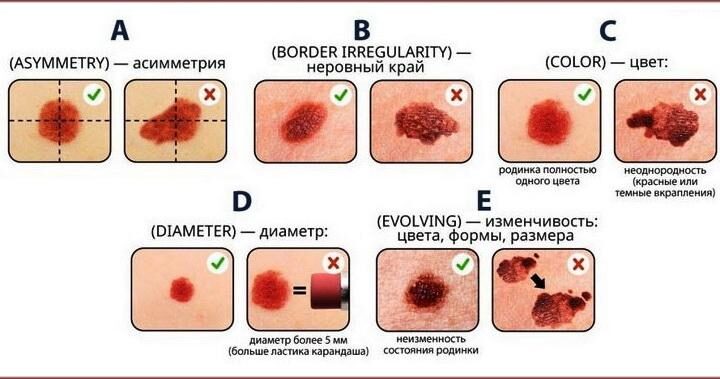 Пігментний невус: види, лікування. Видалення пігментного невуса