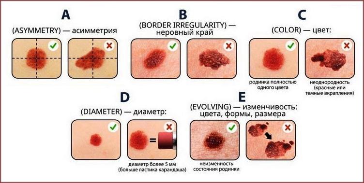 Пігментний невус: види, лікування. Видалення пігментного невуса