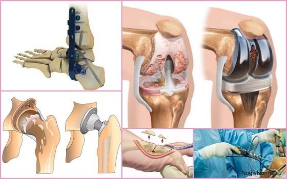 Різновиди операцій при артрозі