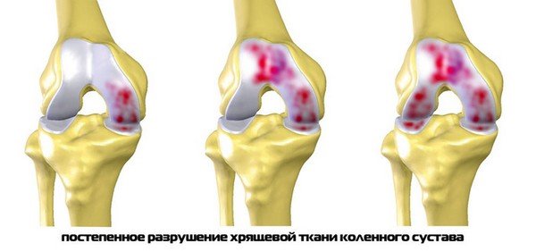 руйнування хряща суглоба