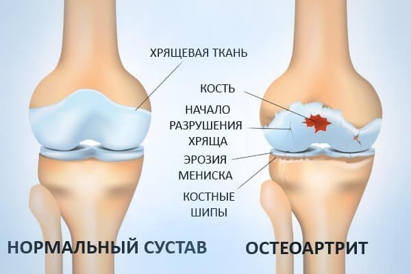 руйнування хрящової тканини при остеоартриті