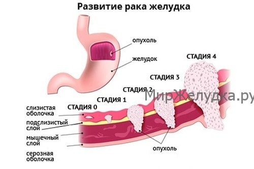 Розвиток раку шлунка