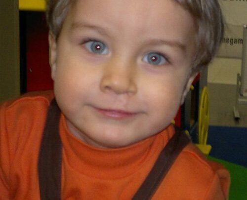 Операція зі зміни форми, контуру або обсягу губ – хейлопластика