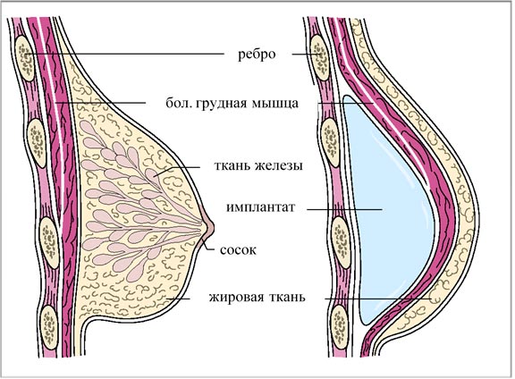 Реконструкція грудей після мастектомії: що нового