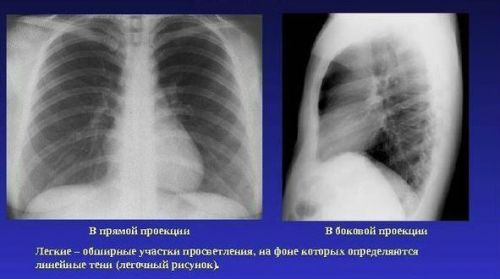 Рентген легенів в 2 проекціях
