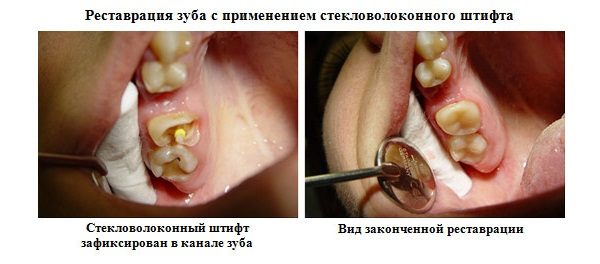 Реставрація зуба із застосуванням стекловолоконного штифта