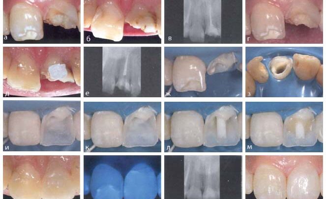Як називається лікар, який вставляє зуби, хто займається виготовленням протезів, як знайти хорошого фахівця?