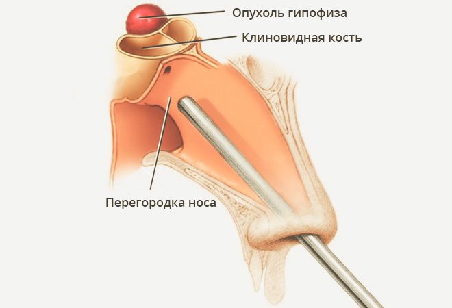 Резекція через клиноподібну кістку