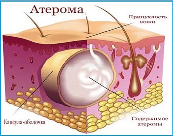 малюнок атероми