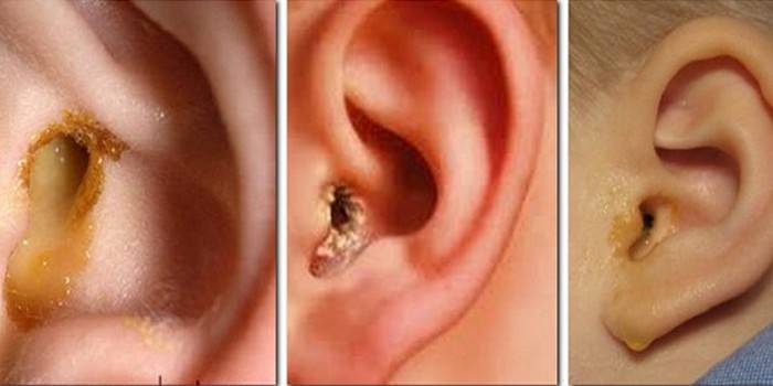 Чи можна самостійно видалити пробку з вуха?