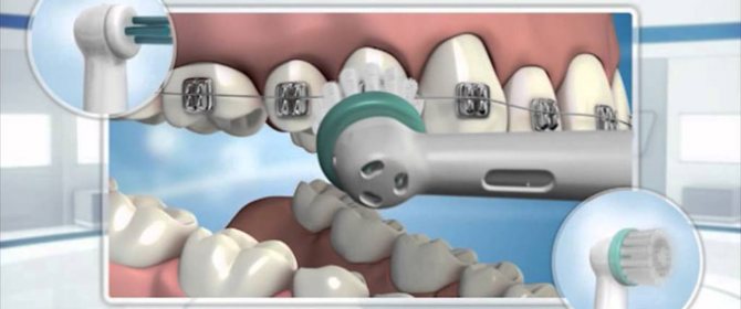 щітки для чищення брекетів