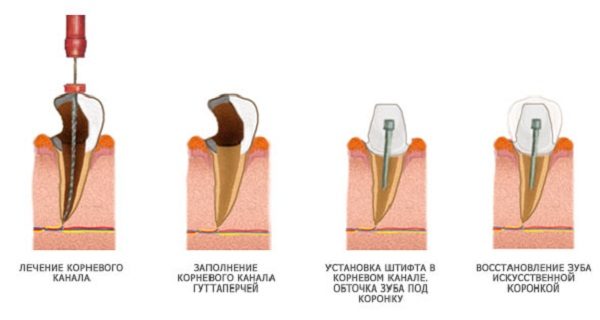 Штифт в корень зуба фото